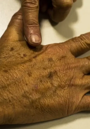 Desinformação sobre câncer de pele afeta diagnóstico, diz instituição