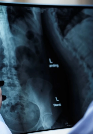 Osteoporose atinge homens e mulheres de maneira diferente; veja cuidados