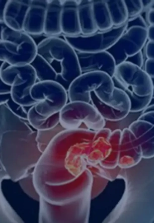 Rastreamento para câncer colorretal pode ser implementado no SUS