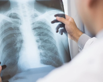 Anvisa aprova novo medicamento para câncer de pulmão avançado